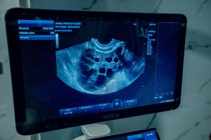 Gamete Intrafallopian Transfer at Angel Fertility Clinic in Nepal.